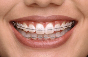 orthodontic treatment in medellin